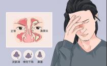 孕期得了鼻炎怎么办
