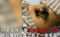 女孩染怪病后腰长出浓密毛发