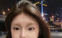 18岁女孩右眼天生蓝瞳