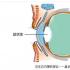 白内障是怎么引起的？