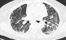 3个办法可提前预警白肺
