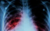 肺部CT需求暴增 检出率约10％-20％
