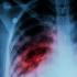 肺部CT需求暴增 检出率约10％-20％
