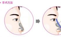  假体鼻尖整形会有哪些优势（鼻尖整形手术比较受欢迎）