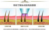冰点永久脱毛会不会对排汗功能有影响呢（没有任何的影响）