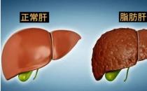 脂肪肝会传染吗 脂肪肝会变成肝癌吗