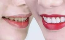 ​美白牙贴对牙齿有没有伤害（有伤害）