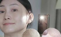 逆光疹形成的原因有哪些
